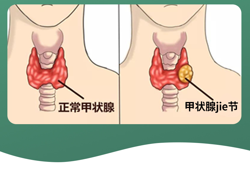 甲狀腺詳情--1_05.jpg